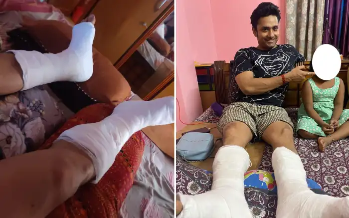 Rubel Das is recuperating at home with a plaster cast on his leg